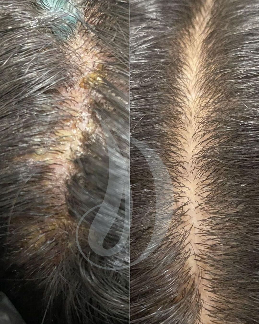 Dermatitis seborreica en el cuero cabelludo, caspa y descamación