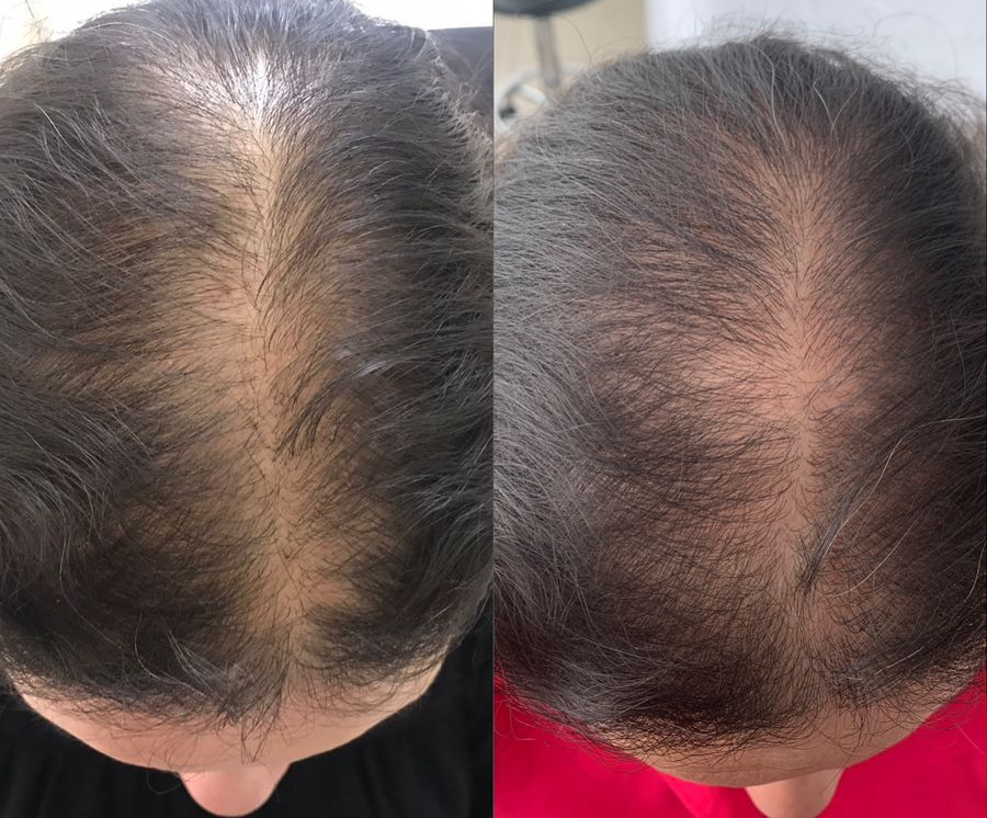 alopecia-androgenetica-patron-coronilla.jpg