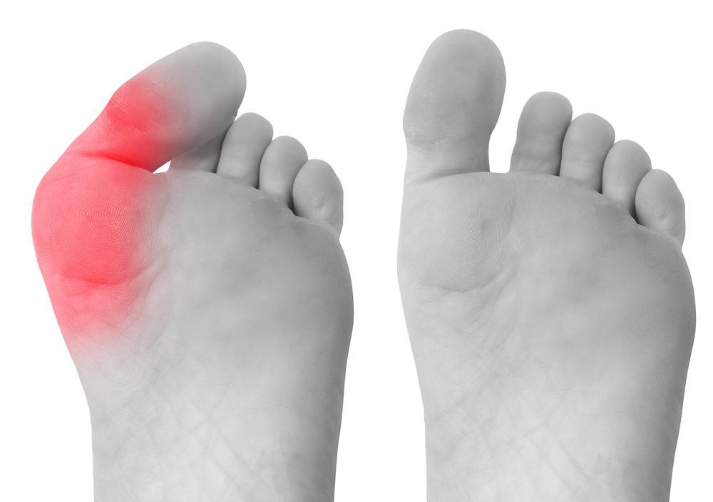 Is Surgery Always Needed To Treat Bunions 