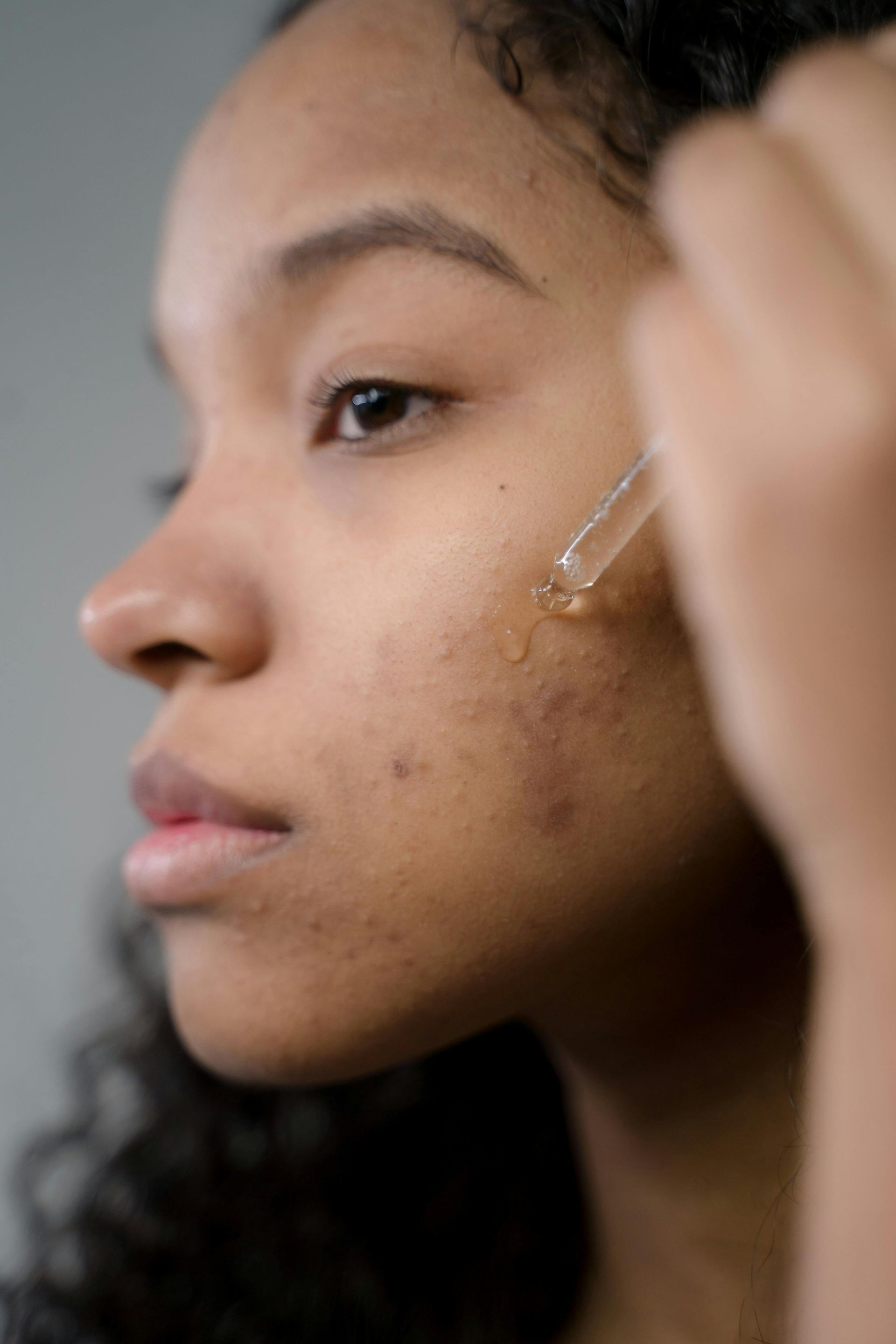 Person applying serum to face with visible acne.
