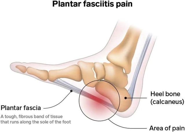 Plantar Fasciitis, Heel Pain