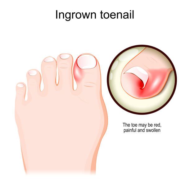 Ingrown Toenail Removal