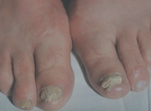 About Fungal Nail Infections