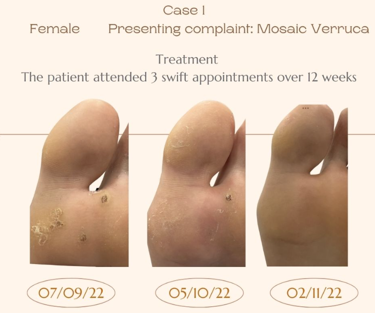 Female Case study of swift results on a verruca