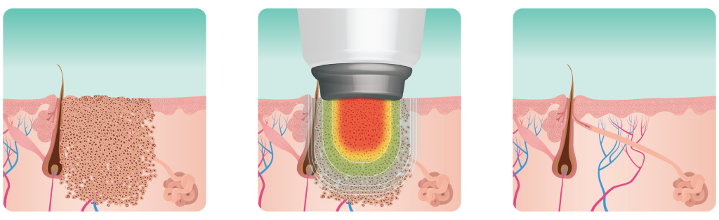 Lazer Treatment of our Verruca in the Dublin Podiatry Clinic