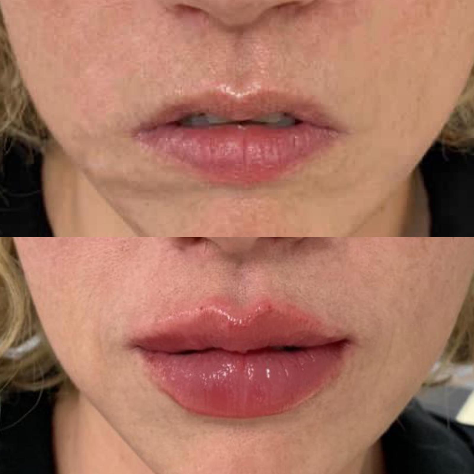 Lip Filler Kings Hill, Kent