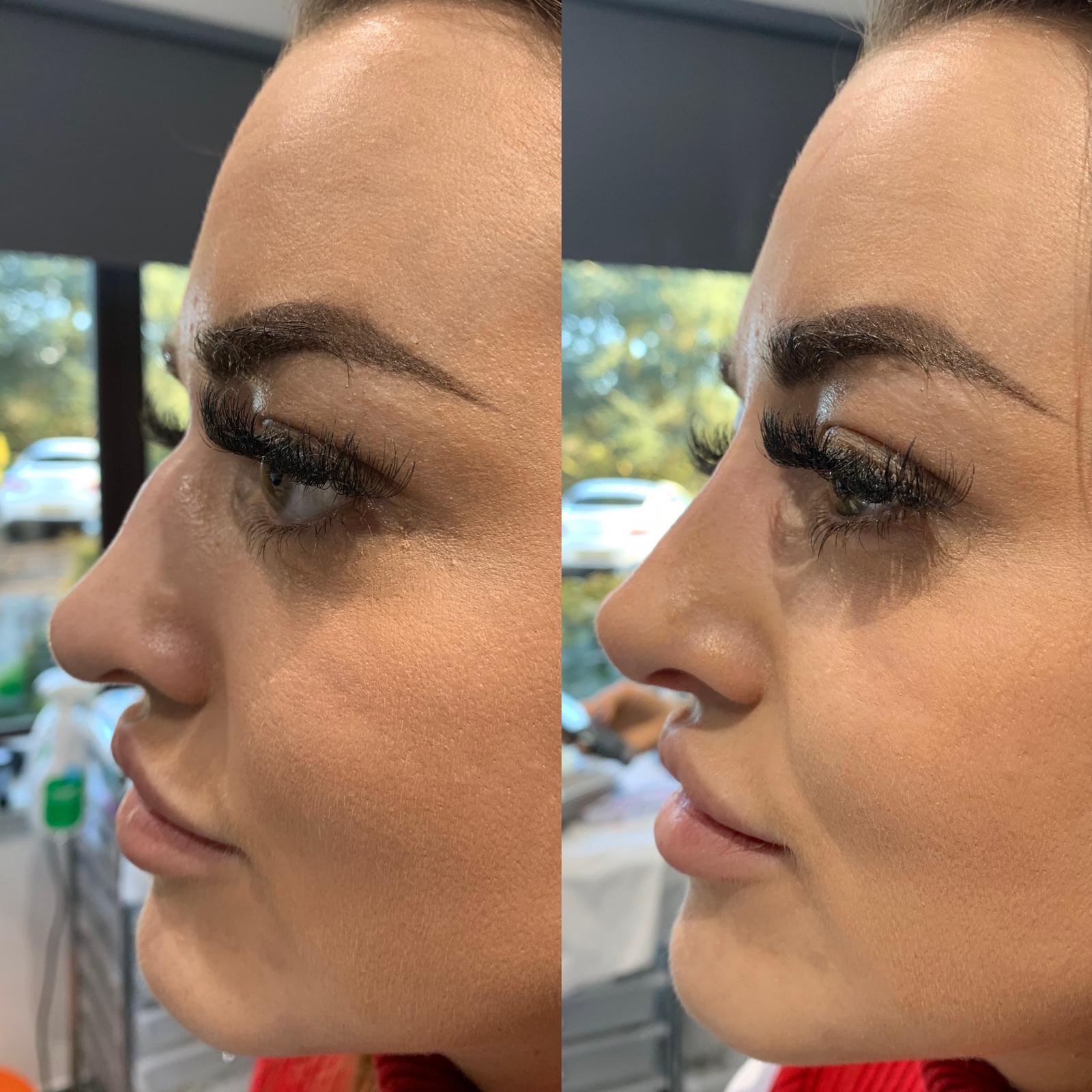 Non Surgical Rhinoplasty Kings Hill, Kent