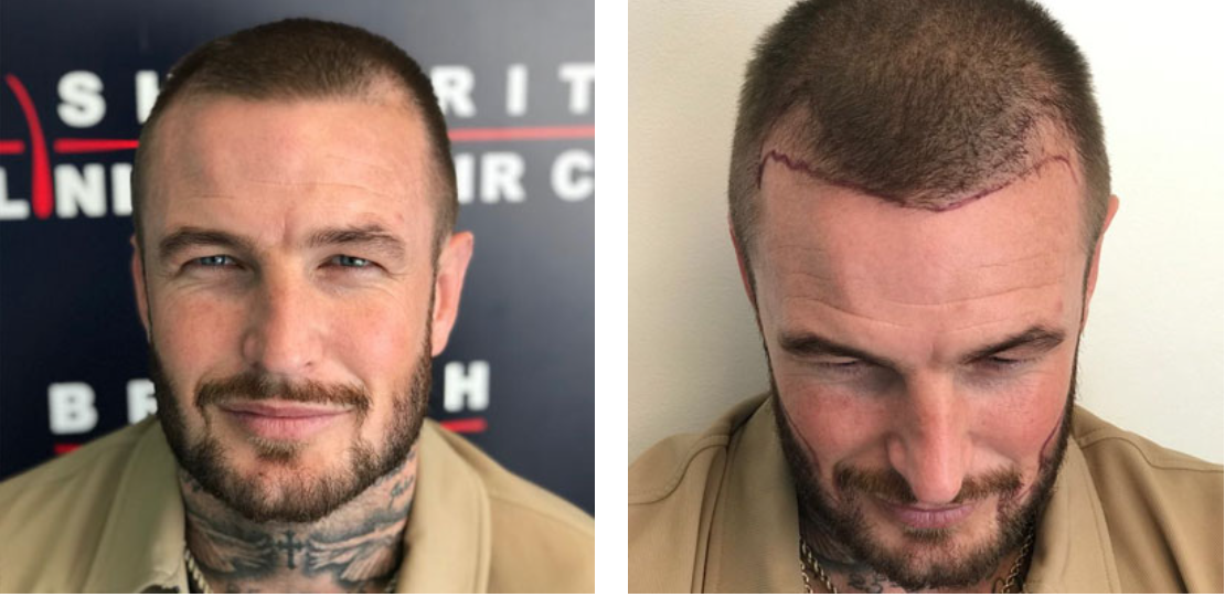 David Beckham Body Double Hair Transplant British Hair Clinic