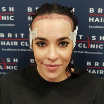 Stephanie Davis | Hollyoaks | Hair Transplant Treatment