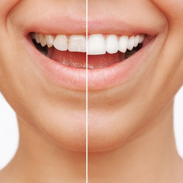 Cropped shot of a young smiling woman before and after dental veneers, isolated on a background.