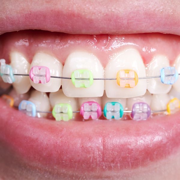 Tooth-Coloured Braces — Paddington, QLD — Essential Dental Group