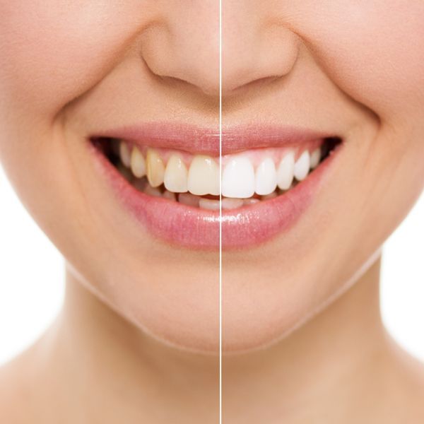 Before and After Teeth Whitening — Paddington, QLD — Essential Dental Group