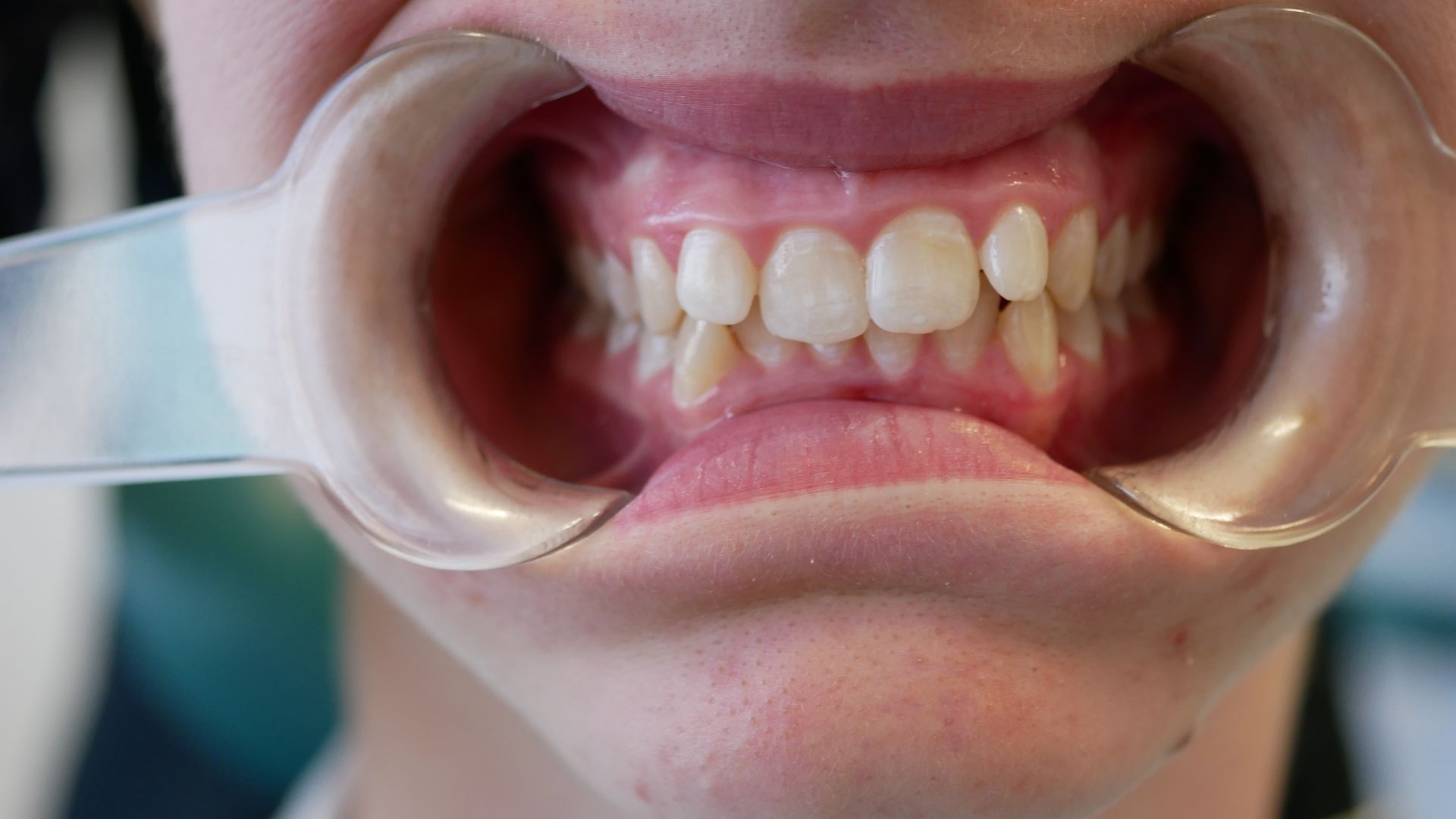 A close up of a person 's mouth with a mouth guard.
