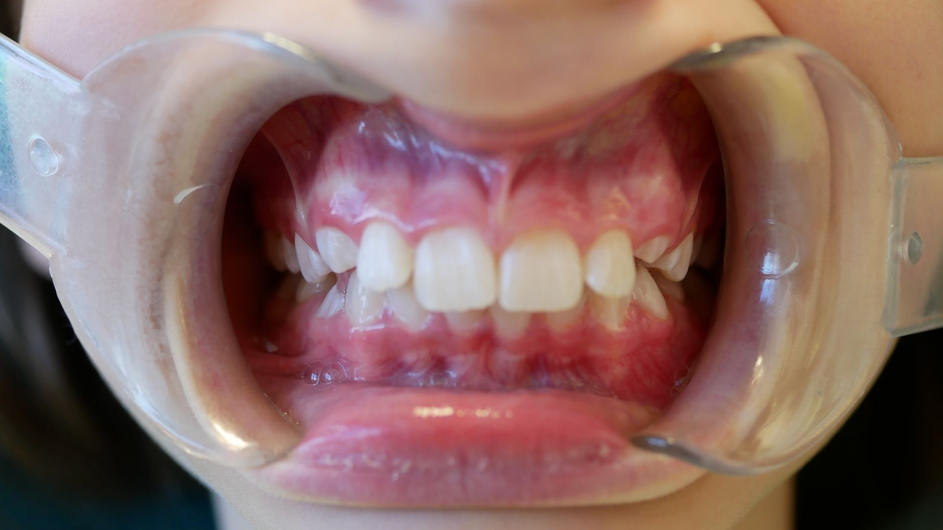 A close up of a person 's mouth with a mouth guard on.