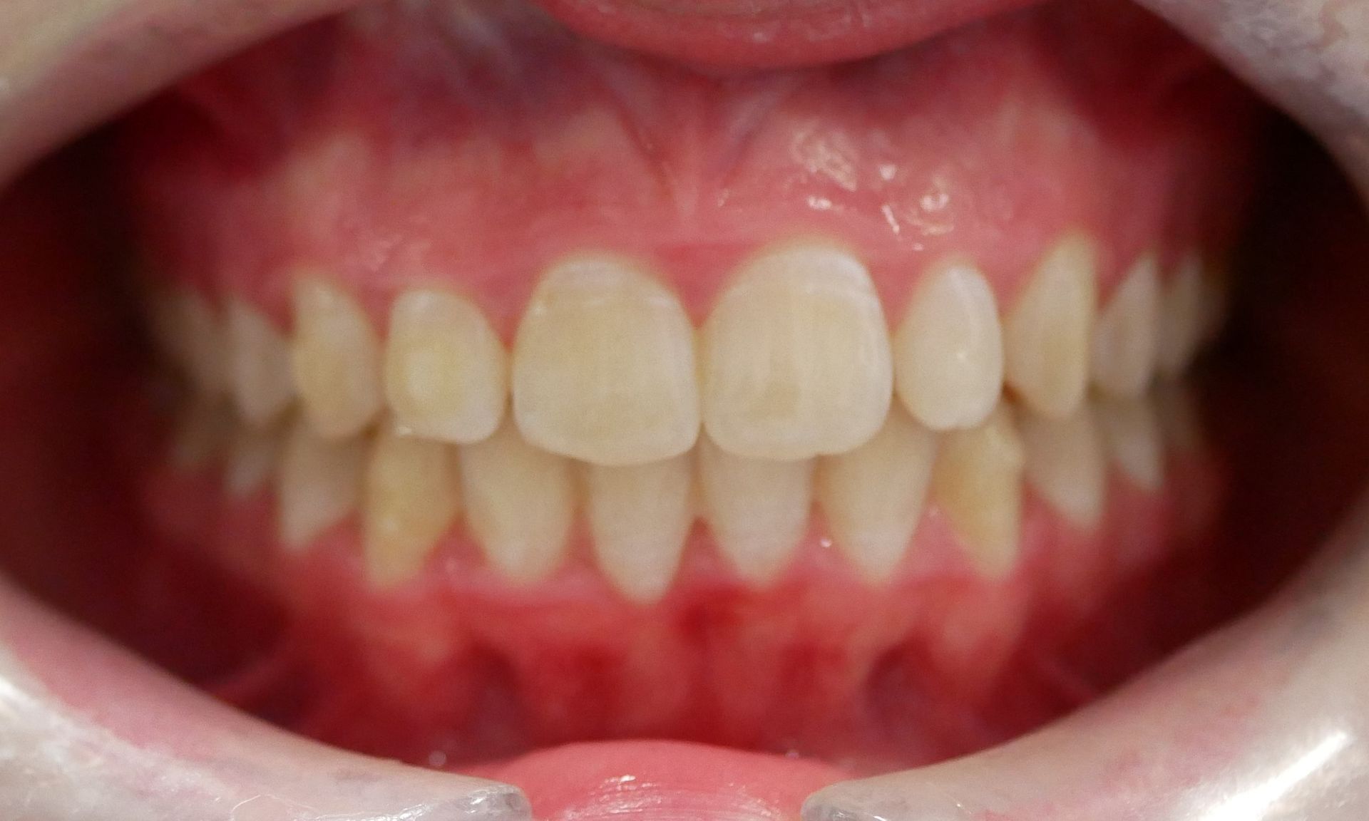A close up of a person 's mouth with white teeth.