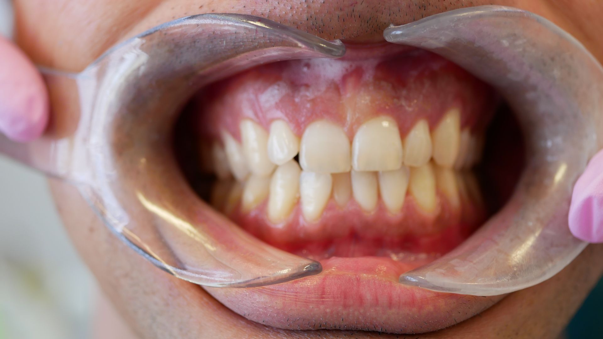 A close up of a person 's mouth with a mouth guard.