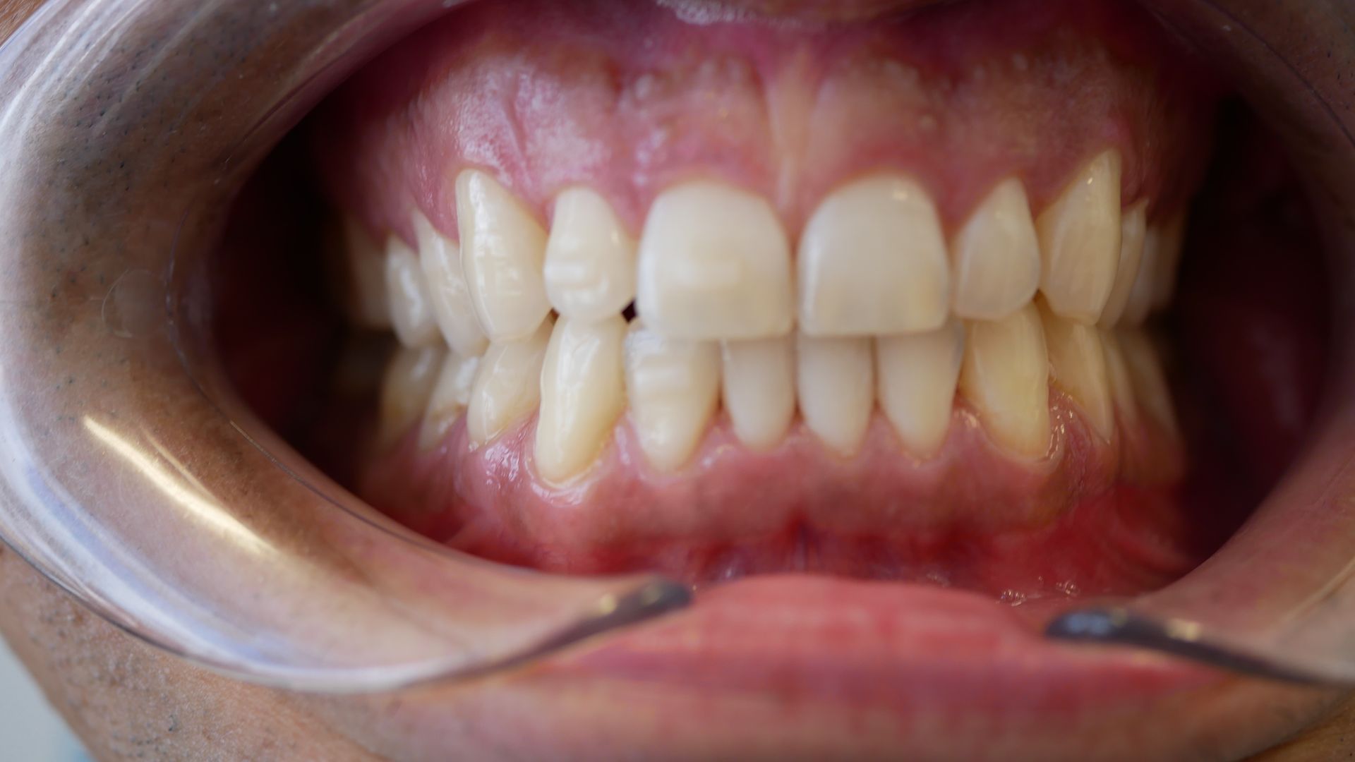 A close up of a person 's teeth with a mouth guard.