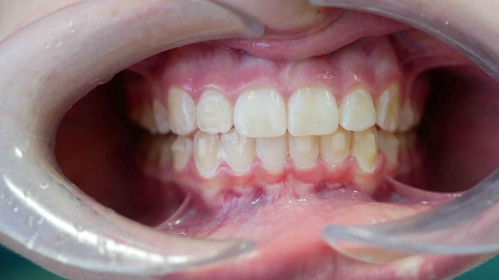 A close up of a person 's teeth with a clear mouth guard.