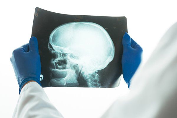 Head Injury — Doctor Examining X-ray of Patient's Skull in Chicago, IL