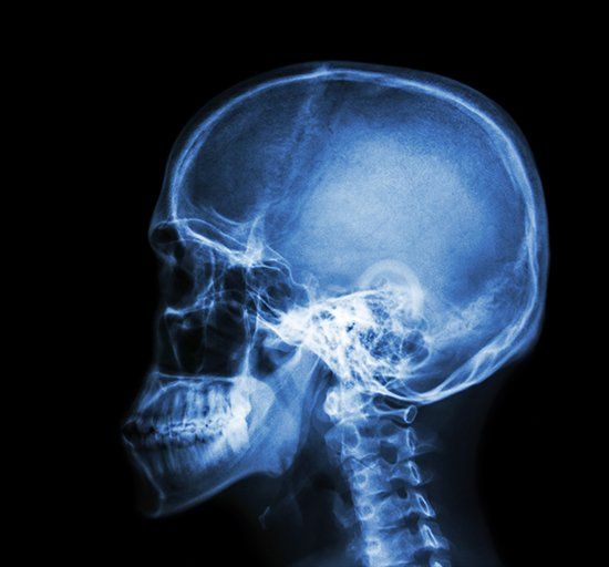 Brain injury symptoms — Film X-Ray Skull And Cervical Spine Lateral View in Chicago, IL