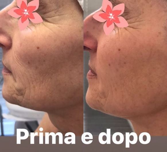 prima e dopo trattamenti estetica