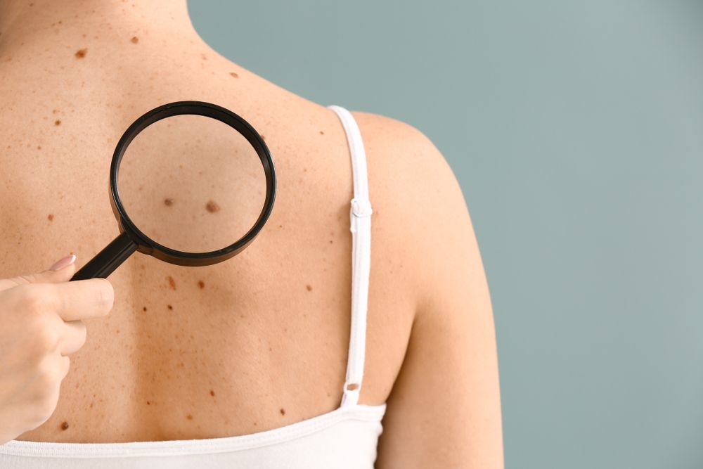 Magnifying Glass Examining a Mole on a Person Bare Back — Hope Laser and Beauty Clinic In Forster, NSW