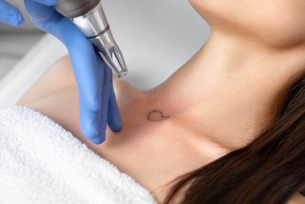 Laser Tattoo Removal on a Person's Collarbone  — Hope Laser and Beauty Clinic In Forster, NSW