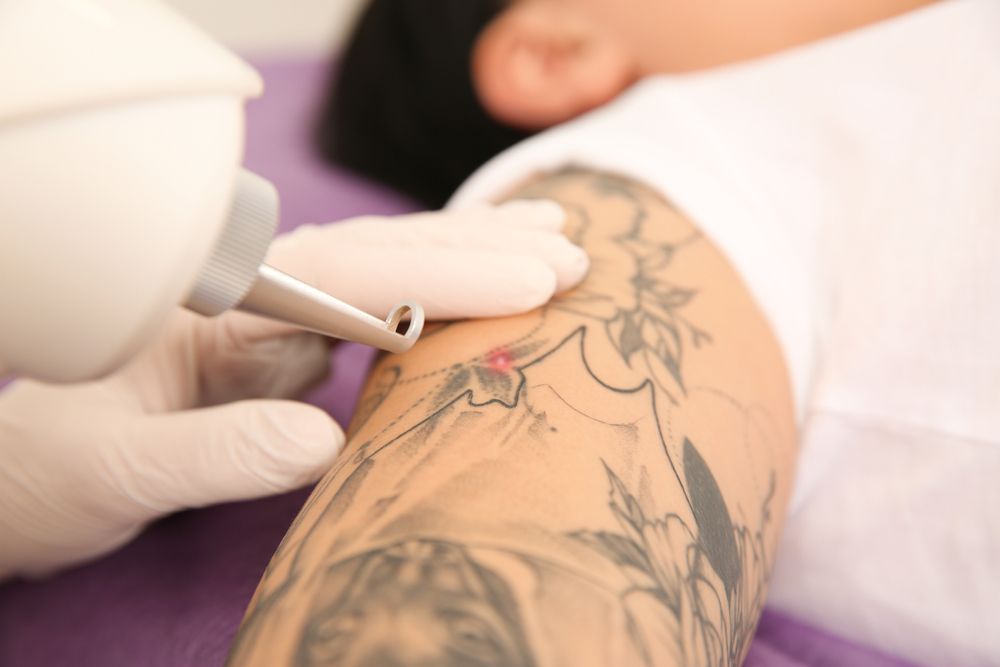 Person Receiving Laser Tattoo Removal on Their Arm — Hope Laser and Beauty Clinic In Tuncurry, NSW