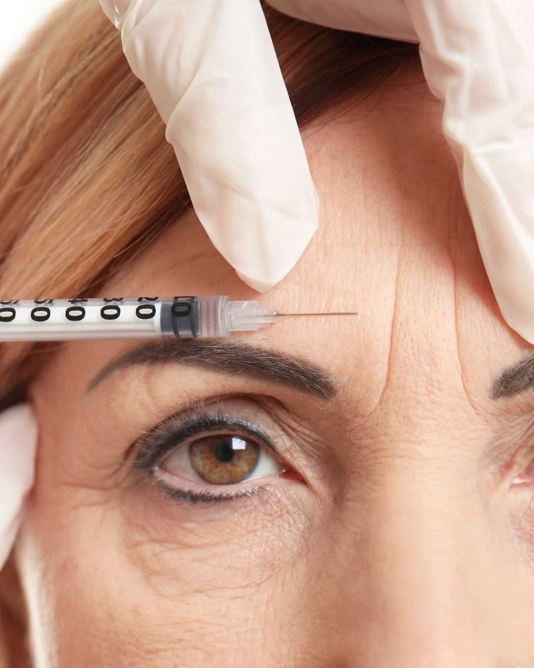 Gloved hand injecting a syringe into a woman's forehead near the eyebrow