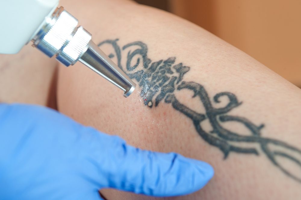 Laser Removing Black Tattoo From Skin on Leg — Hope Laser and Beauty Clinic In Taree, NSW