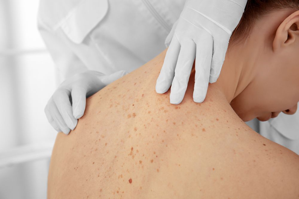 Doctor Examining a Patient's Back Covered in Moles — Hope Laser and Beauty Clinic In Tuncurry, NSW