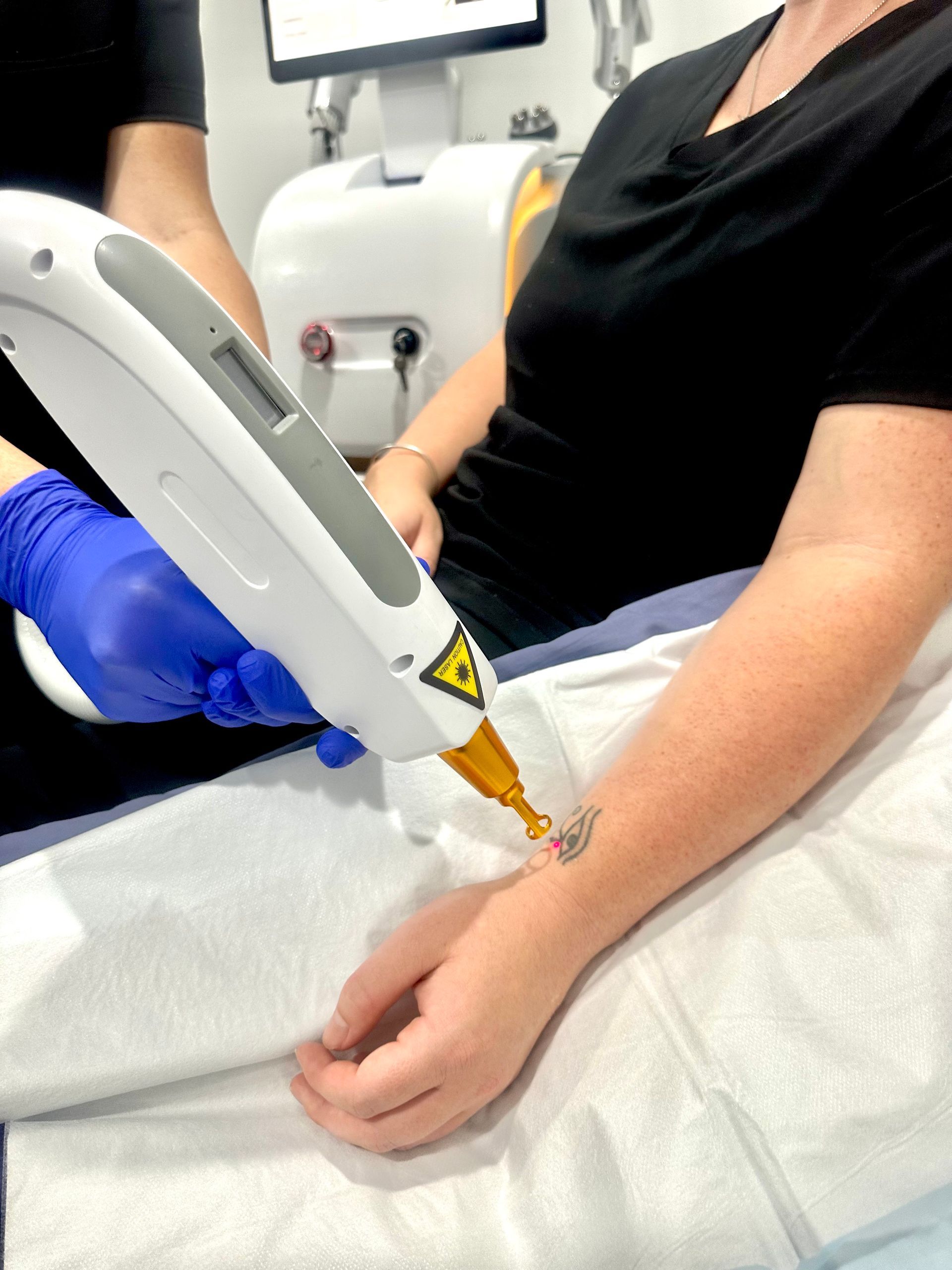 Person Getting Laser Tattoo Removal — Hope Laser and Beauty Clinic In Tuncurry, NSW