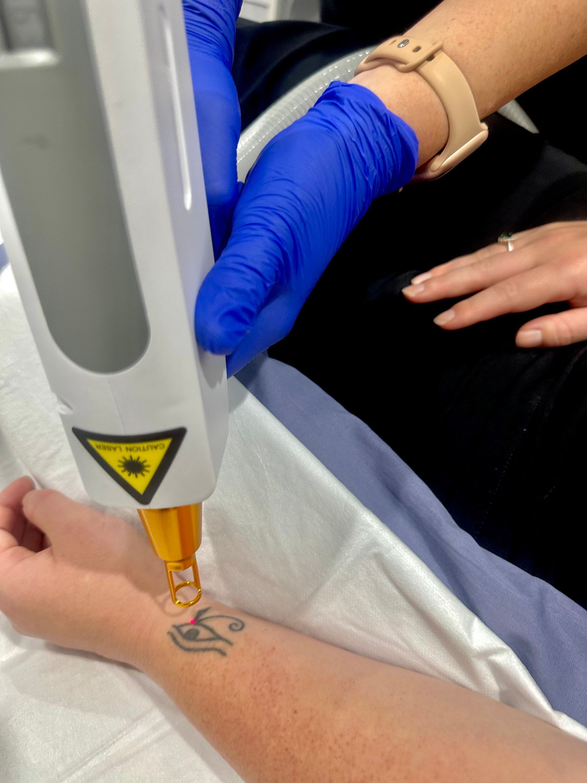 Laser Tattoo Removal on a Wrist — Hope Laser and Beauty Clinic In Tuncurry, NSW