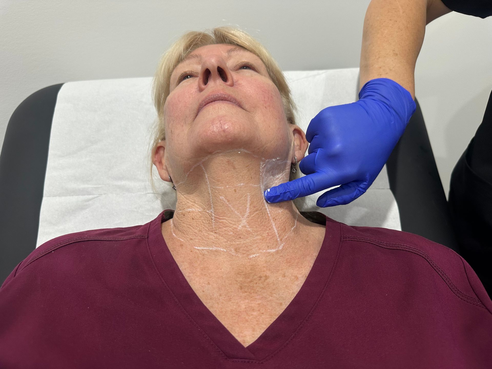 Person's neck marked with lines, being pointed to by gloved hand. Preparing for a procedure. — Hope Laser and Beauty Clinic In Tuncurry, NSW