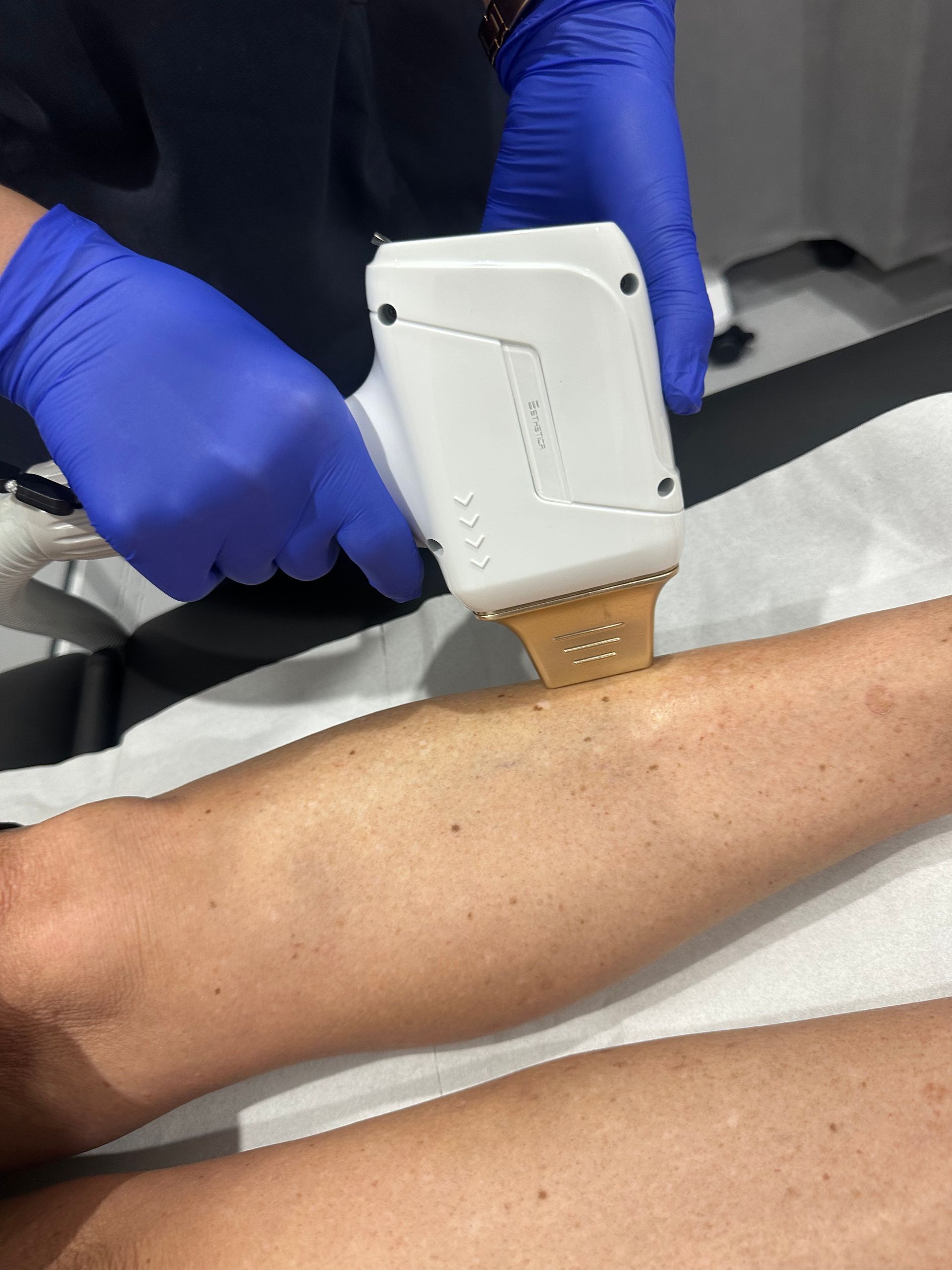 Leg being treated with a laser hair removal device; gloved hands holding the device against the skin. — Hope Laser and Beauty Clinic In Tuncurry, NSW