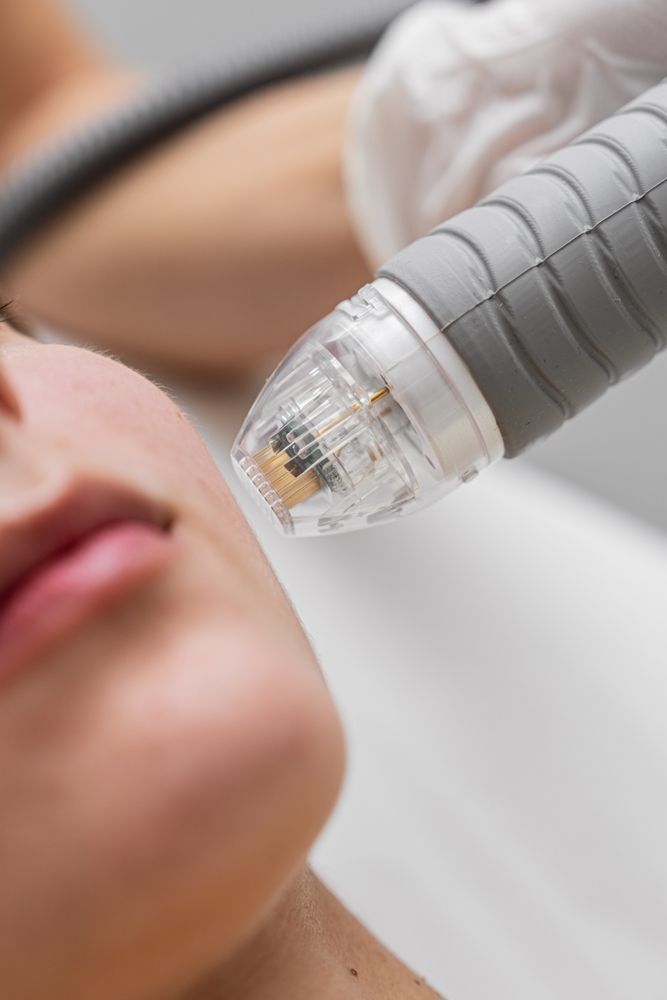 Microneedling Treatment on a Person's Cheek — Hope Laser and Beauty Clinic In Forster, NSW