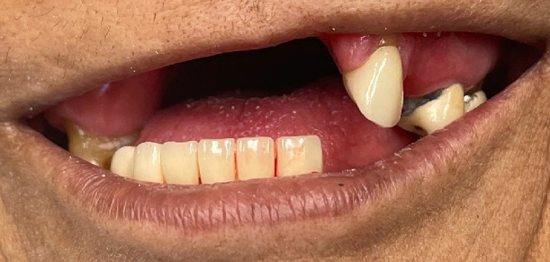 Before Partial Dentures