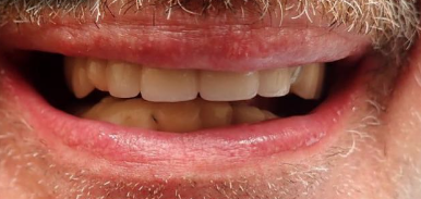 Before Partial Dentures