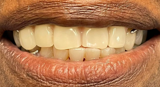After Partial Dentures