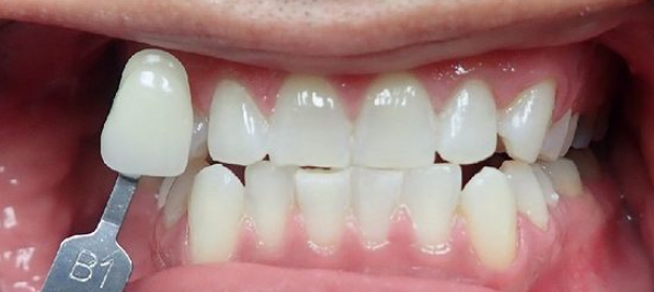 After Zoom Whitening