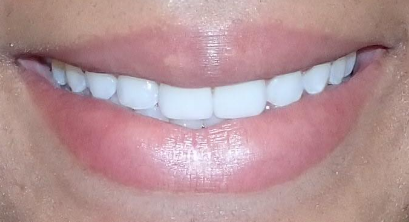 After Invisalign and Laminates