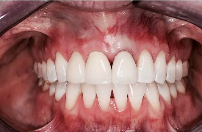 A close up of a person 's teeth with white teeth.