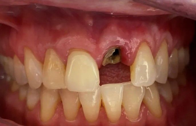 A close up of a person 's teeth with a tooth missing.