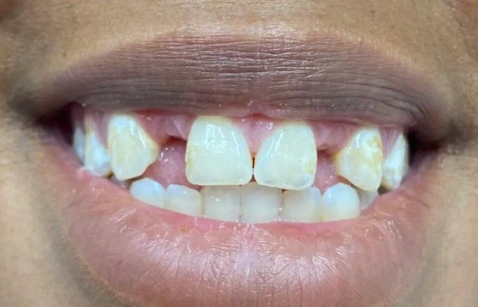 A close up of a person 's mouth with missing teeth.