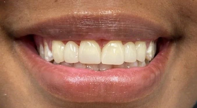 A close up of a woman 's mouth with white teeth.