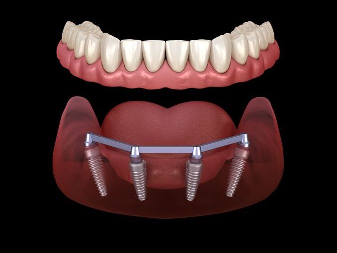 A computer generated image of a full denture with dental implants