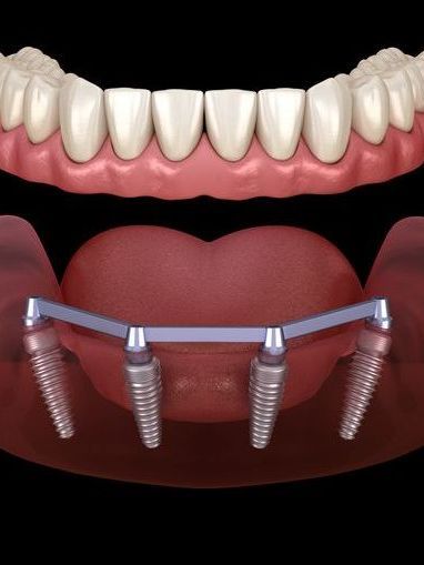 A computer generated image of a full denture with dental implants.