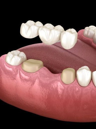 A computer generated image of a dental bridge in a person 's mouth.