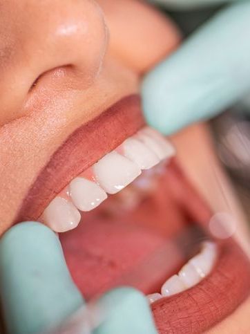 A woman is getting her teeth examined by a dentist.