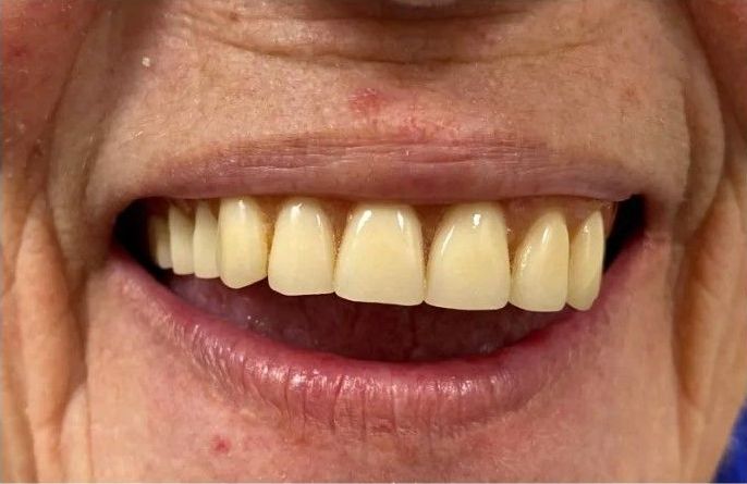 A close up of a person 's teeth with a smile on their face.